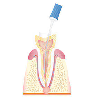 Reinigung des Zahninneren und Entfernung des erkrankten Zahnnervs